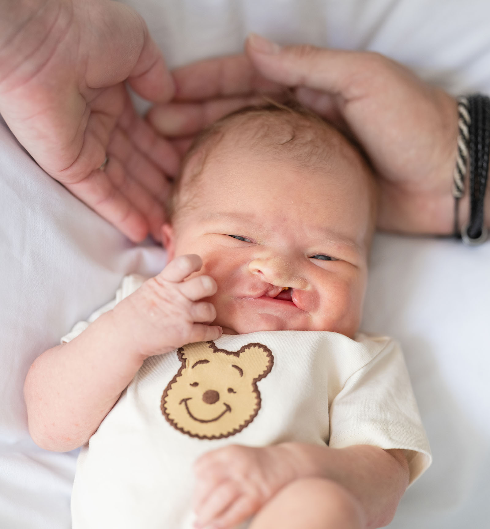 baby walker - flinders medical center newborn photography 8 Newborn baby with cleft lip cradled by adult hands, showcasing love and warmth.
