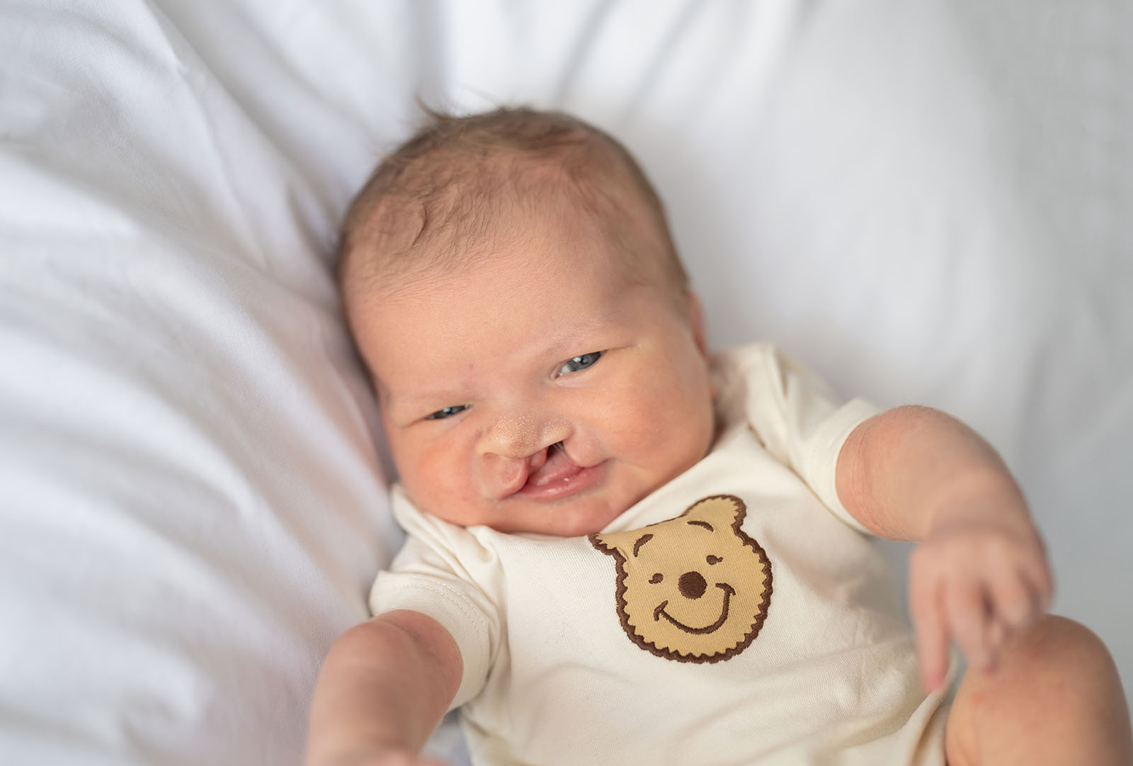 baby walker - flinders medical center newborn photography 7 Newborn baby lying on white pillow in onesie, featuring cleft lip, conveying innocence and warmth.
